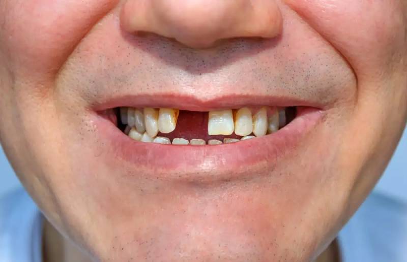 Ý nghĩa giấc mơ thấy răng gãy: Chỉ là lo âu hay còn nhiều hơn thế?